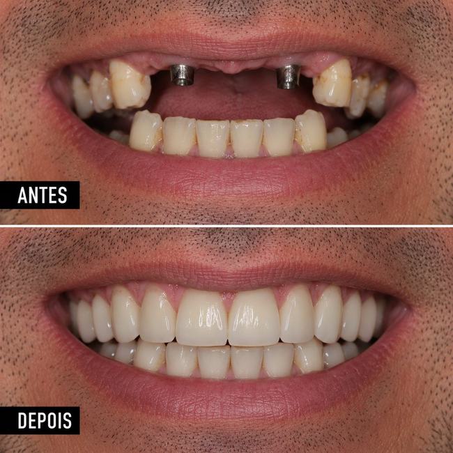 Antes e depois de implante dentário - Caso 2
