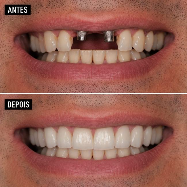 Antes e depois de implante dentário - Caso 3