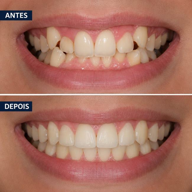 Antes e depois de implante dentário - Caso 4