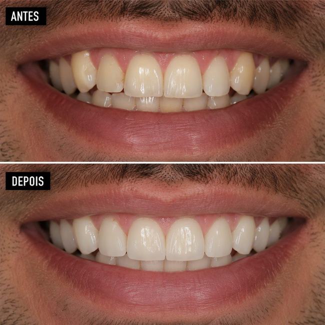 Antes e depois de implante dentário - Caso 5